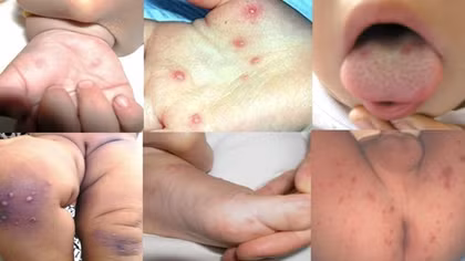 Cảnh báo dịch chồng dịch – tay chân miệng và sốt xuất huyết