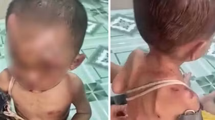 Thông tin mới nhất vụ “Bé trai cơ thể đầy thương tích, nghi bị bạo hành”