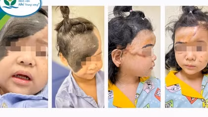Mang đến gương mặt mới cho bé gái có khối u hắc tố khổng lồ