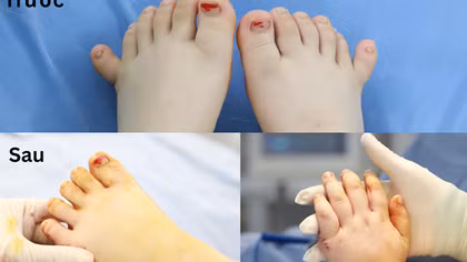 Phẫu thuật thành công cho em bé có đến 24 ngón tay chân hiếm gặp