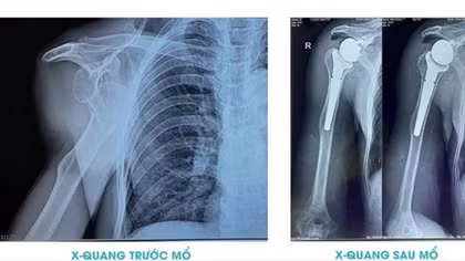 Lần đầu tiên Bệnh viện 199 thực hiện thành công phẫu thuật thay khớp vai toàn phần đảo ngược