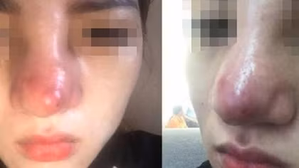 Hai bệnh nhân bị tai biến và “lột” sạch tài sản sau khi vào nhà nghỉ tiêm filler làm đẹp