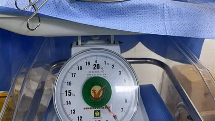 Mổ "bắt con" và bóc tách khối u buồng trứng 8kg cho sản phụ