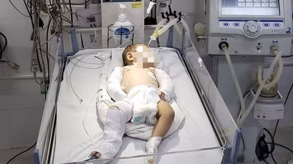 Bé gái 2 tháng tuổi gãy hai tay, chân, hôn mê sâu nghi bị bạo hành