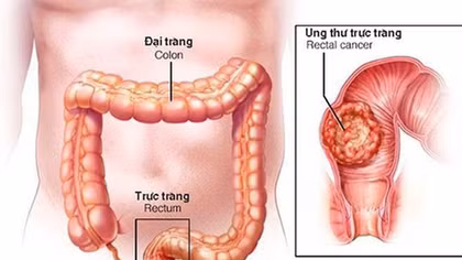 15 tuổi đã mắc ung thư đại tràng, cảnh báo bệnh ngày càng trẻ hóa