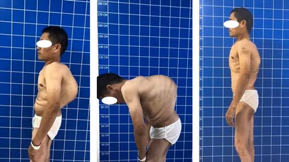 Tái sinh cho người đàn ông 40 tuổi "siêu gù"