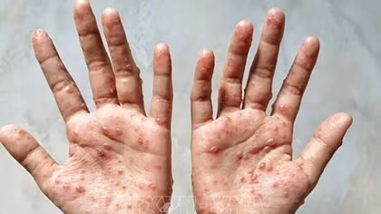 Chủ động tìm nguồn vaccine, thuốc điều trị khi có ca bệnh đậu mùa khỉ xâm nhập