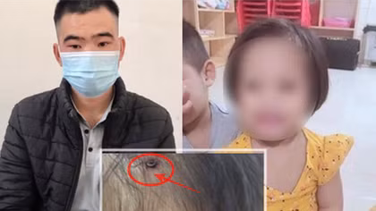 Hà Nội yêu cầu xử lý nghiêm vụ cháu bé bị đóng đinh vào đầu