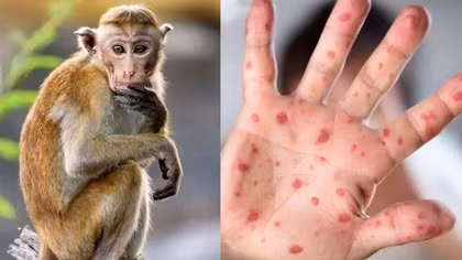 Bộ Y tế đưa đậu mùa khỉ vào danh mục bệnh truyền nhiễm nhóm B