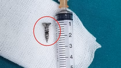 Kịp thời cứu cháu bé 22 tháng tuổi bị đinh vít 1,5cm găm vào phế quản