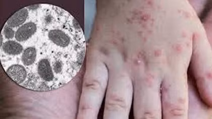 Đo thân nhiệt khách nhập cảnh để phát hiện sớm bệnh đậu mùa khỉ