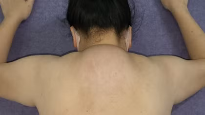 Phẫu thuật cứu người phụ nữ mắc bệnh "bướu con bò" hiếm gặp