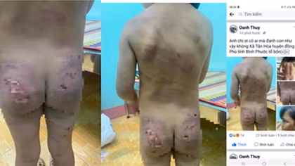 Bé gái 7 tuổi ở Bình Phước nghi bị bạo hành dã man