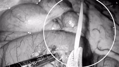Xương cá hơn 2,5cm đâm xuyên thủng ruột non một phụ nữ