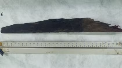 Cứu sống bệnh nhân bị thanh gỗ đâm xuyên phổi