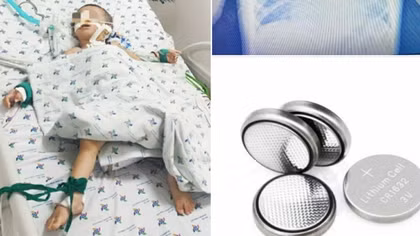 Bé trai 3 tuổi nguy kịch vì nuốt pin cúc áo