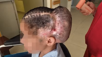 Biến chứng kinh hoàng sau cấy mỡ thái dương: Một phụ nữ suýt mất mạng vì đột quỵ