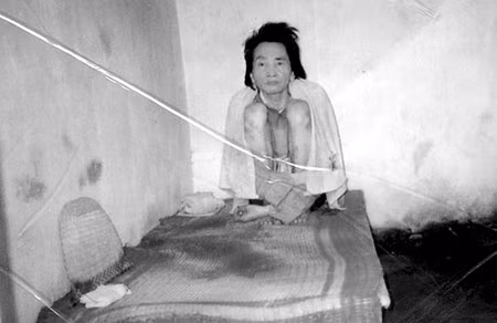 Anh Minh bị xích trong nhà đã 26 năm.