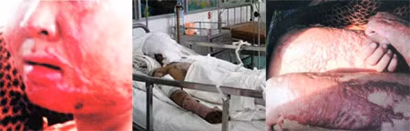 Cháu Hiệp lúc điều trị tại Bệnh viện Nhi Đồng 1, TPHCM.