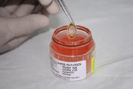 Ghép giác mạc sẽ giúp người bị hỏng giác mạc thấy lại ánh sáng.