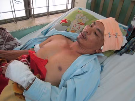 Ông Bùi Đình Chung vẫn phải nằm viện với thương tích khắp người.