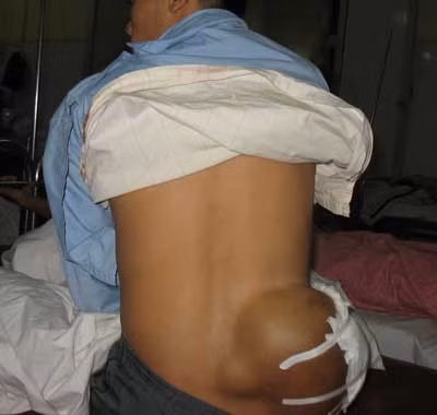 Bệnh nhân Mai Văn Tính bị u ở hông.