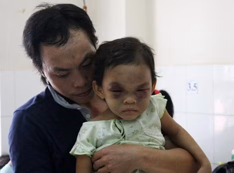 Khuôn mặt cháu Ngân vẫn còn sưng húp khi gặp cha ruột của mình.