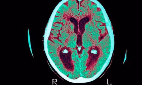 Hình ảnh não bộ mắc bệnh Alzheimer.