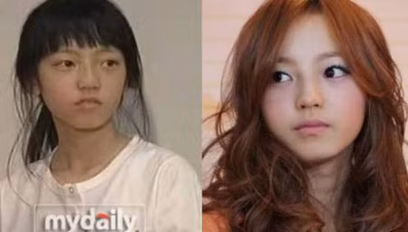 Hara, thành viên nhóm nhạc nữ Kara của K-pop, trước và sau phẫu thuật thẩm mỹ.