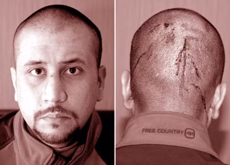 George Zimmerman với vết thương ở đầu.