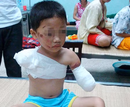 Cháu Vũ Hoàng Quân bị gấu cắn cụt hai tay.