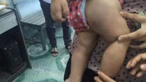 Bé gái 8 tháng tuổi nghi bị bảo mẫu đánh bầm tím 