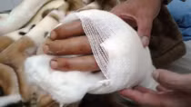  Nối thành công cổ tay bị chém đứt lìa