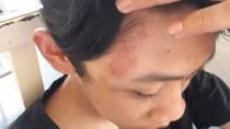 Nam sinh lớp 9 bị đánh hội đồng tới nhập viện