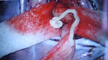 Sán nhái 7cm nằm trong não người đàn ông