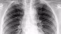 Thông tin bệnh nhân ở Tây Ninh nhiễm virus Corona là sai sự thật