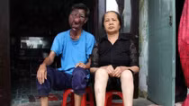 Chuyện đời buồn tủi của người đàn ông "mặt quỷ"