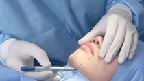 Nỗ lực chấn chỉnh hoạt động phẫu thuật thẩm mỹ
