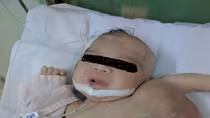 Bé gái sơ sinh có khối u khổng lồ to gần bằng cơ thể