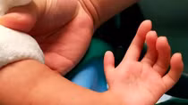 Phẫu thuật thành công bàn tay chữ L cho bé trai 2 tuổi 