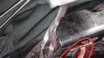 Cứu sống bệnh nhân bị tổn thương mạch máu trong lồng ngực