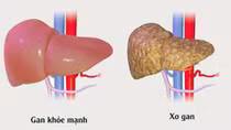 Khoảng 8,7 triệu người Việt Nam nhiễm vi rút viêm gan B