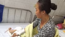Những sai lầm tai hại trong xử lý vết bỏng ở trẻ em