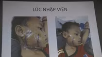 Lấy lại khuôn mặt cho bệnh nhi bị cánh quạt công nghiệp "chém nát"