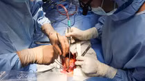 Bệnh nhân đầu tiên được mổ tim tại Bệnh viện cấp quận 