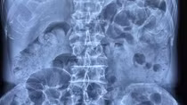 Lần đầu tiên thực hiện thành công đặt stent điều trị ung thư đại trực tràng tại phía Nam