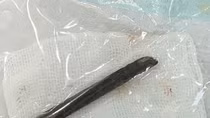 Khúc đũa 7 cm bị "bỏ quên" trong hốc mũi bệnh nhân suốt 4 năm