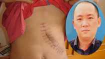 Làm giấy tờ giả, môi giới mua bán thận trái phép 