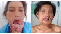 Phẫu thuật thành công trường hợp ung thư môi hiếm gặp