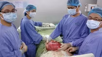 Phẫu thuật thành công khối u khổng lồ trong ổ bụng bệnh nhân